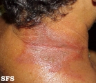 paederus dermatitis
