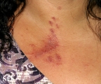 paederus dermatitis
