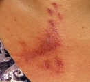 paederus dermatitis