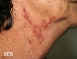 paederus dermatitis