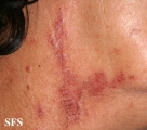 paederus dermatitis