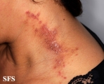 paederus dermatitis