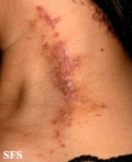 paederus dermatitis