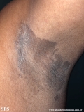 erytrasma