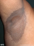 erytrasma