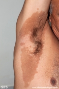 erytrasma