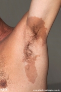 erytrasma