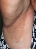 erytrasma