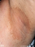 erytrasma