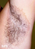 erytrasma