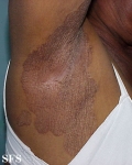 erytrasma