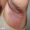erytrasma