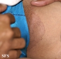 erytrasma