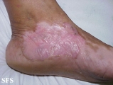woringer kolopp disease