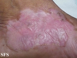 woringer kolopp disease