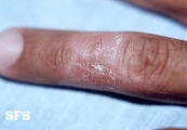 woringer kolopp disease