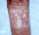 woringer kolopp disease