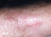 woringer kolopp disease
