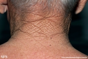 cutis rhomboidalis nuchae