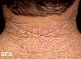 cutis rhomboidalis nuchae