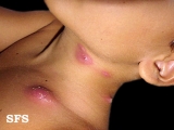 periporitis