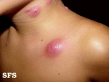 periporitis