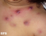 periporitis