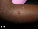 culicosis bullosa