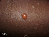 culicosis bullosa