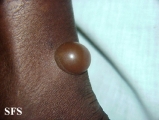 culicosis bullosa