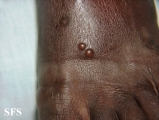 culicosis bullosa
