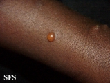 culicosis bullosa