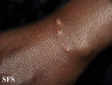 culicosis bullosa