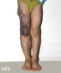 klippel trenaunay syndrome