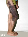 klippel trenaunay syndrome