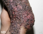 klippel trenaunay syndrome
