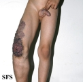 klippel trenaunay syndrome