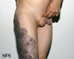 klippel trenaunay syndrome