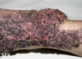 klippel trenaunay syndrome
