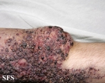 klippel trenaunay syndrome