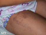 glanzmann's thrombasthenia