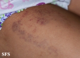 glanzmann's thrombasthenia