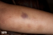 glanzmann's thrombasthenia
