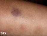 glanzmann's thrombasthenia