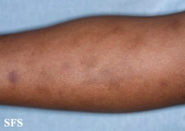 glanzmann's thrombasthenia