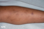 glanzmann's thrombasthenia