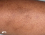 glanzmann's thrombasthenia
