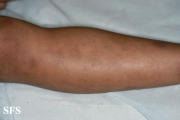 glanzmann's thrombasthenia