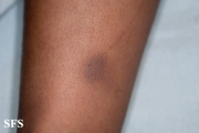 glanzmann's thrombasthenia
