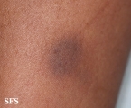 glanzmann's thrombasthenia